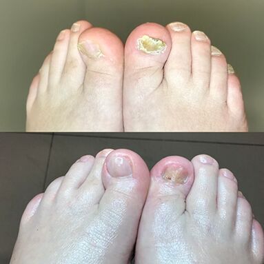 Experiencia no uso de Promicil Cream Barnabas de Israel, foto antes e despois