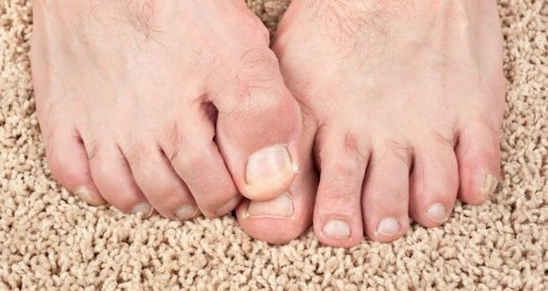 Síntomas do fungo das uñas