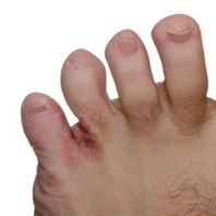 fungo entre os dedos