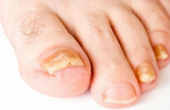 O fungo no polgar da perna