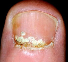 Síntomas e signos da enfermidade