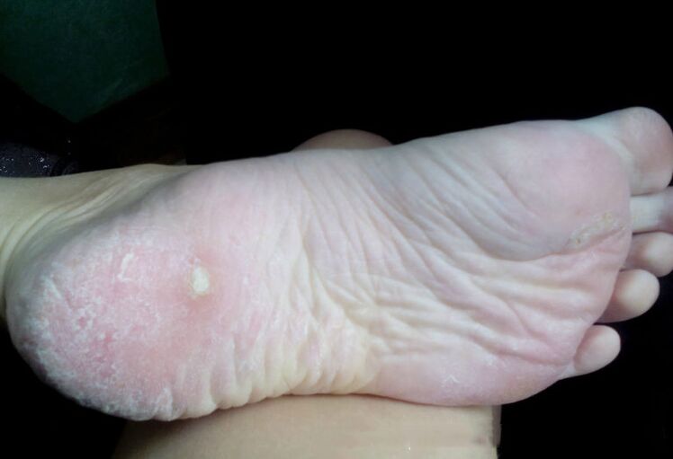 Tratamento do fungo cun láser