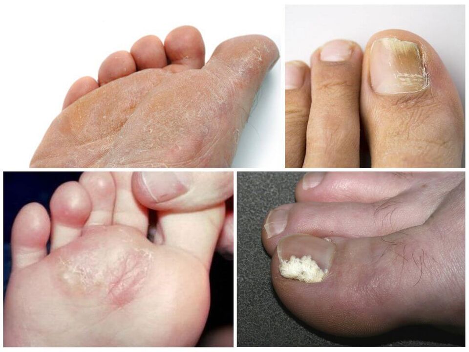 A fase inicial do fungo no pé