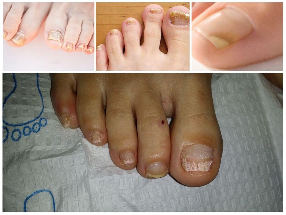 Enfermidades fúngicas das placas ungueais