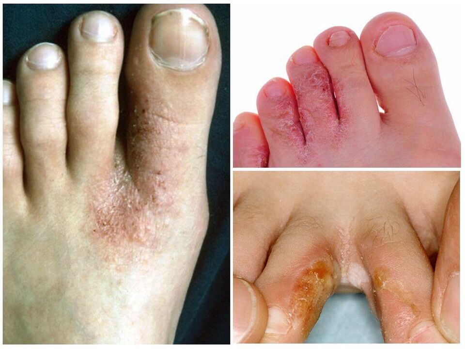 Micose interdixital
