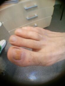 fase inicial do fungo das unhas do dedo gordo do pé