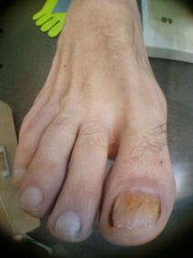 fungo das unhas do dedo gordo