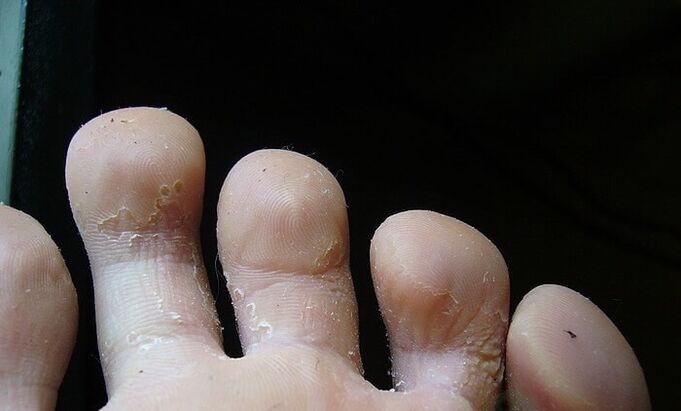 fase inicial do fungo