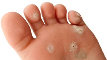 segunda fase da infección fúngica