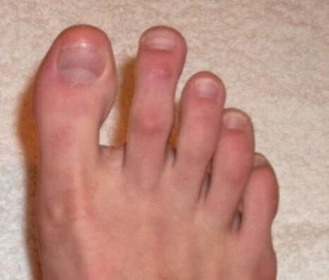 unhas despois do tratamento con láser para fungos