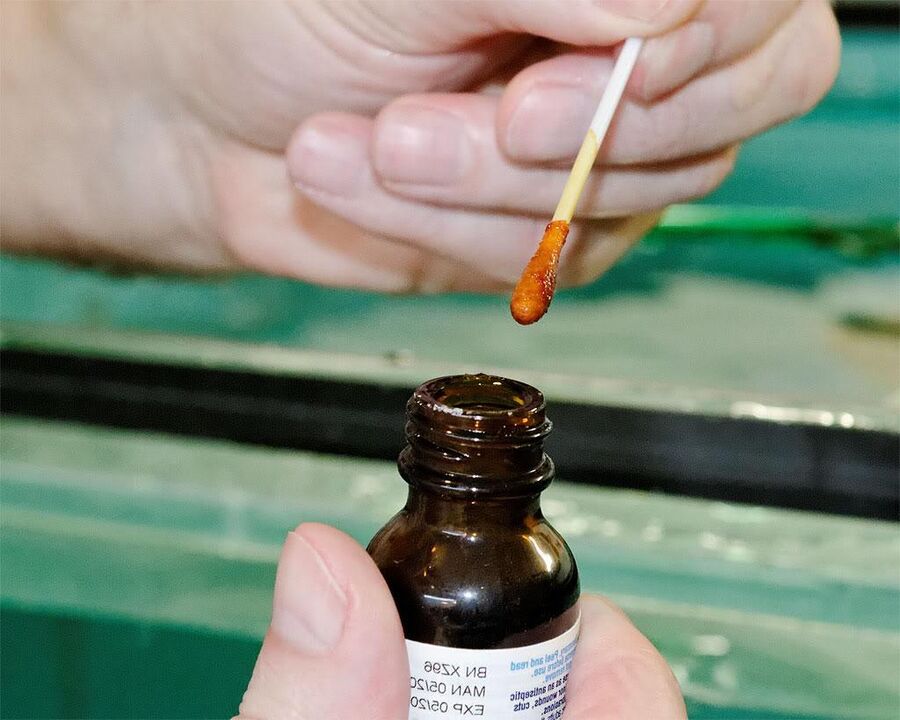Aplicar unha mestura de iodo e zume de celidonia nas uñas dos pés eliminará os fungos